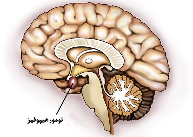 تومور هیپوفیز