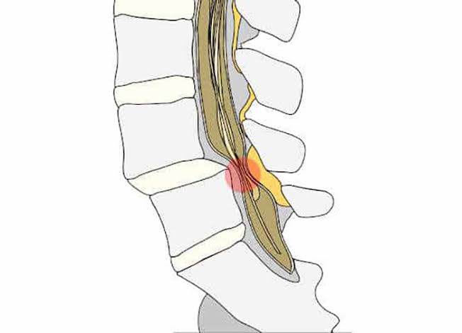 spinal-stenosis-diagnosis-treatment
